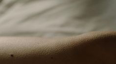 Can AI Predict Which Moles Need Removal?