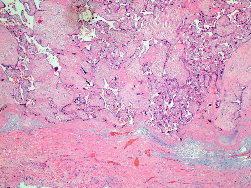 Explainable AI in Cancer Diagnosis