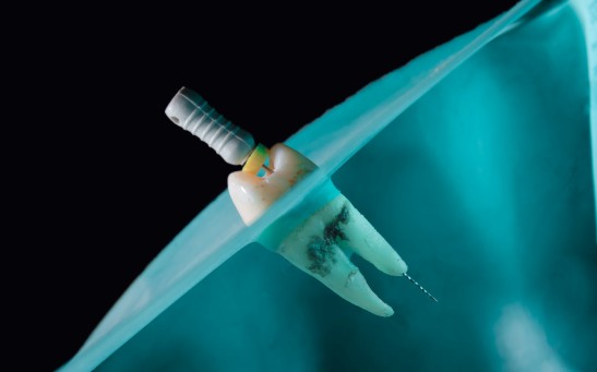 AI-Powered Full Arch Implant Systems 2026