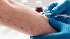 Measles Transmission Persists Across Texas Into Summer 2026 Amid Ongoing