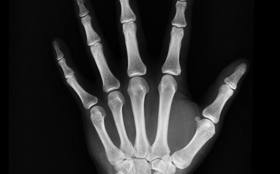 The Most Common Bone Fractures in Adults