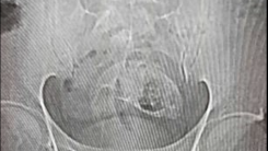 Why Do People Have Rectal Foreign Bodies? A Blue Tilapia is Removed From a Chinese Man's Rectum