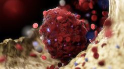 Coronavirus is Linked to Blood Clots in the Legs of Patients