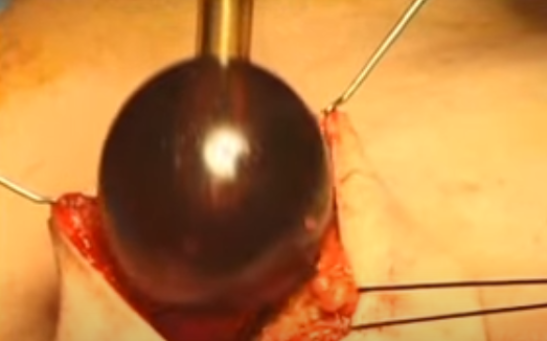 Breast Cancer IORT: TARGeted Intraoperative radioTherapy (TARGIT) with Intrabeam in TARGIT-A trial