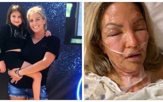 Woman Severely Burned After Hand Sanitizer Caught On Fire and Exploded