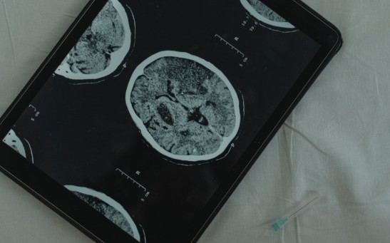 Brain tumor