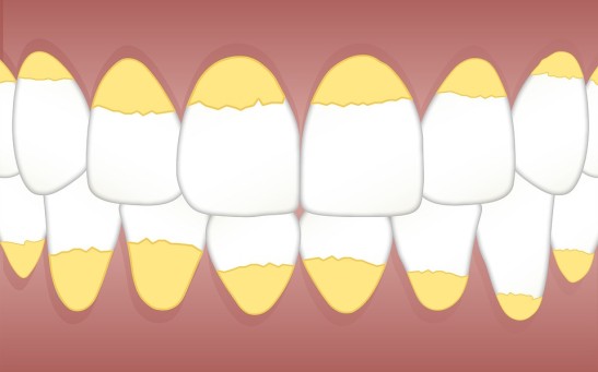 Plaque vs Tartar: Can Teeth Whitening Toothpaste Remove Them