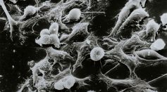 Immunotherapy Drug Dostarlimab Has 100% Efficacy Rate Against A Subset of Rectal Cancer in Promising Study
