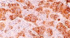 Treatment of Precancerous Lesions in Breast Ducts Can Eliminate All Signs of Early Breast Cancer