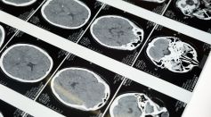 Insoluble Plaques in the Brain Might Not Be the Cause of Alzheimer's Disease, New Theory Suggests