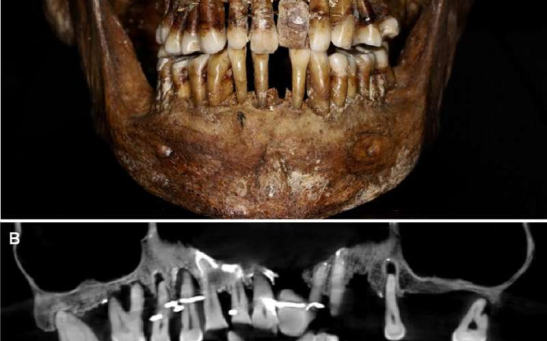The teeth of 17th century French aristocrat Anne d'Alegre, with a gold wire threading through several.