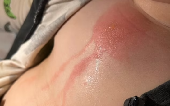 The Tiny Hearts Foundation shared photographs showing a burn covering the chest of the child, as well as blisters and blood