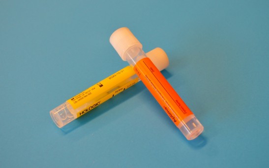 Urine Test With A Novel Type of Nanoparticle Can Detect Cancer for Early Non-Invasive Diagnosis
