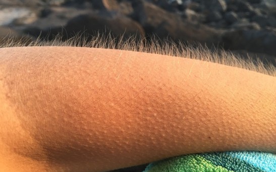 Unveiling the Mystery: The Science Behind Goosebumps and Their Hair-Raising Effect