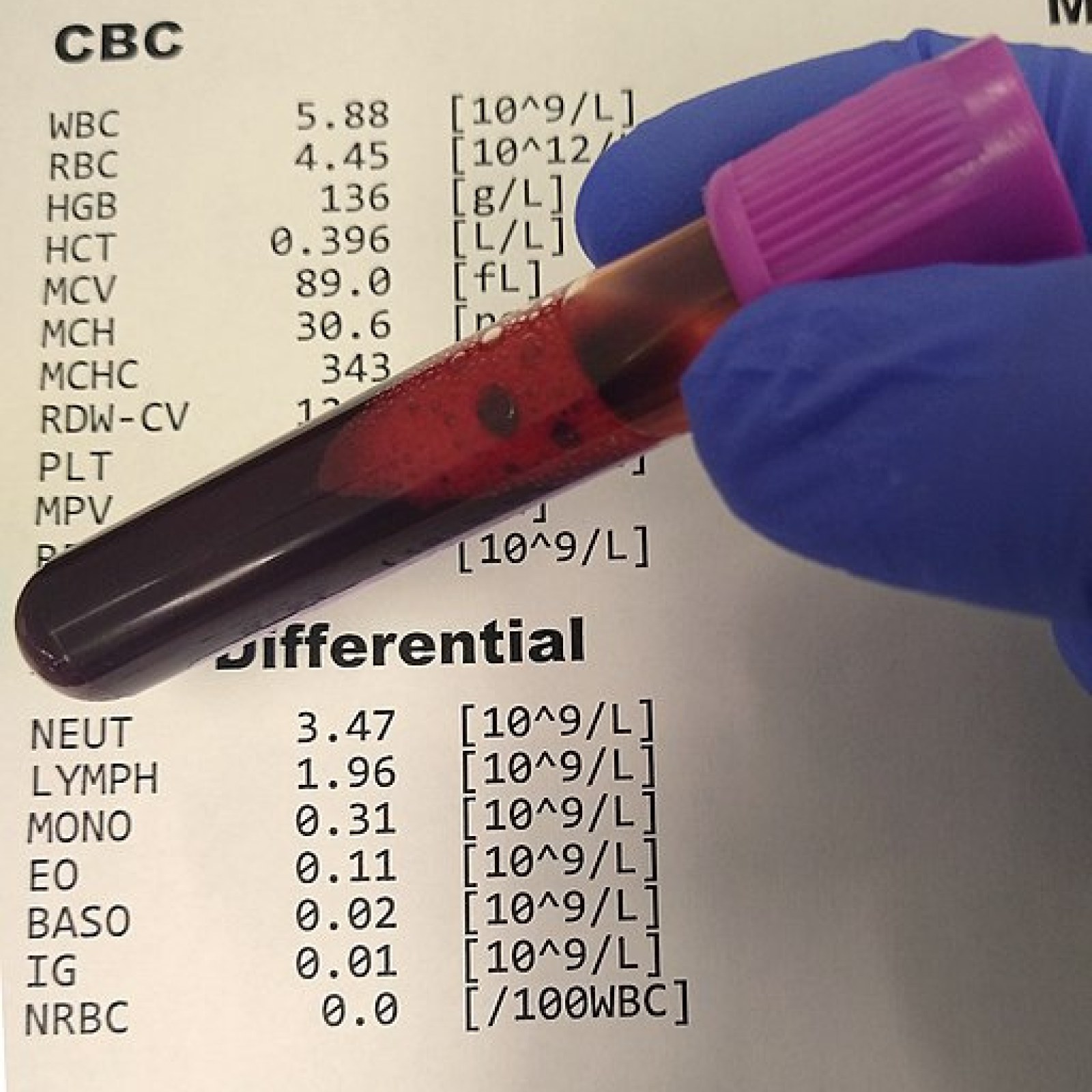 5 Shocking Truths: What Level of RDW Is Dangerous 2 Symptoms That May Accompany Dangerous RDW Levels
